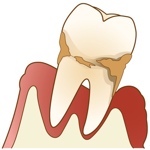 歯周病とは？